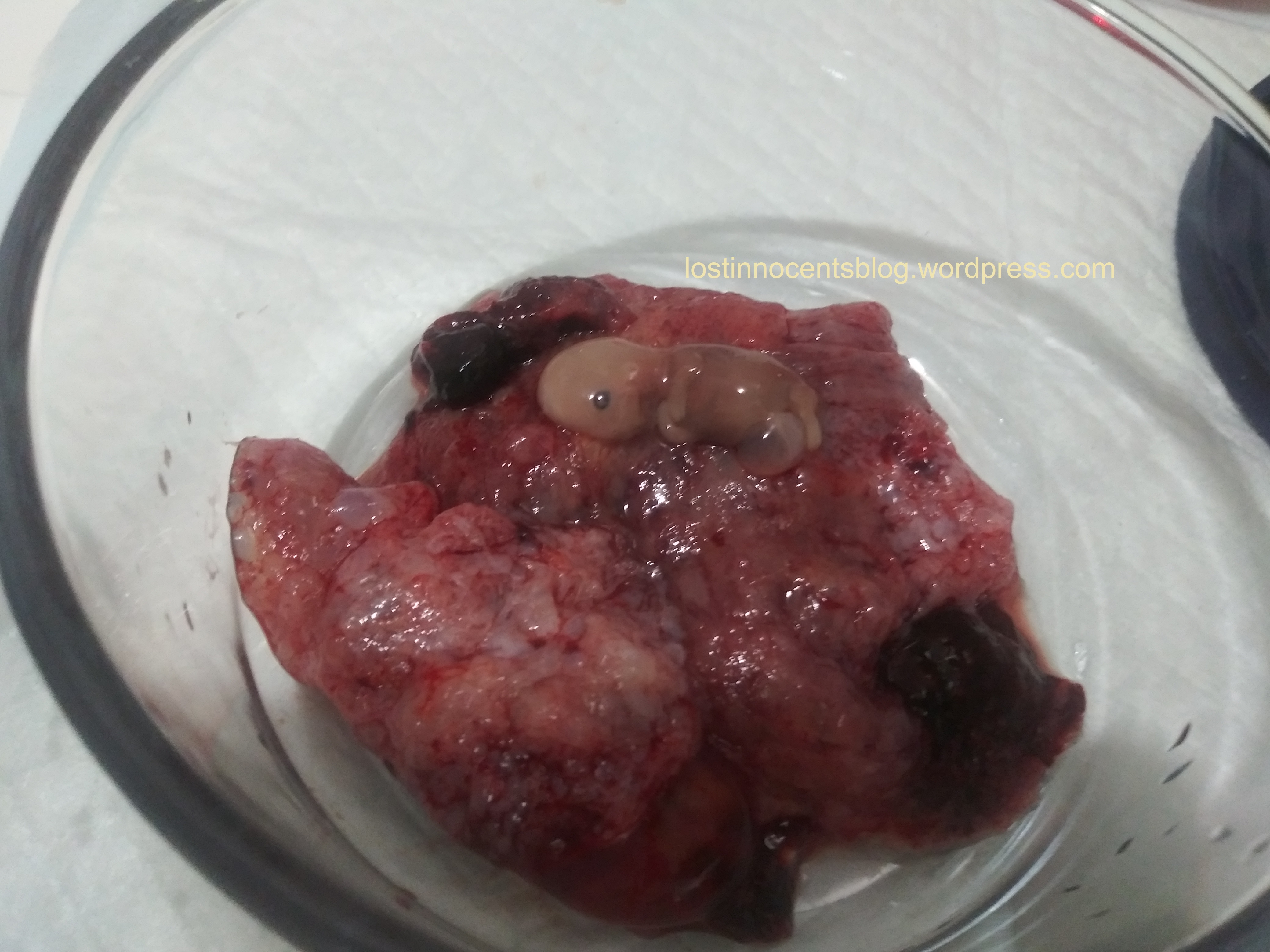 Heavenly's twins - Arrow 11 weeks on placenta WM