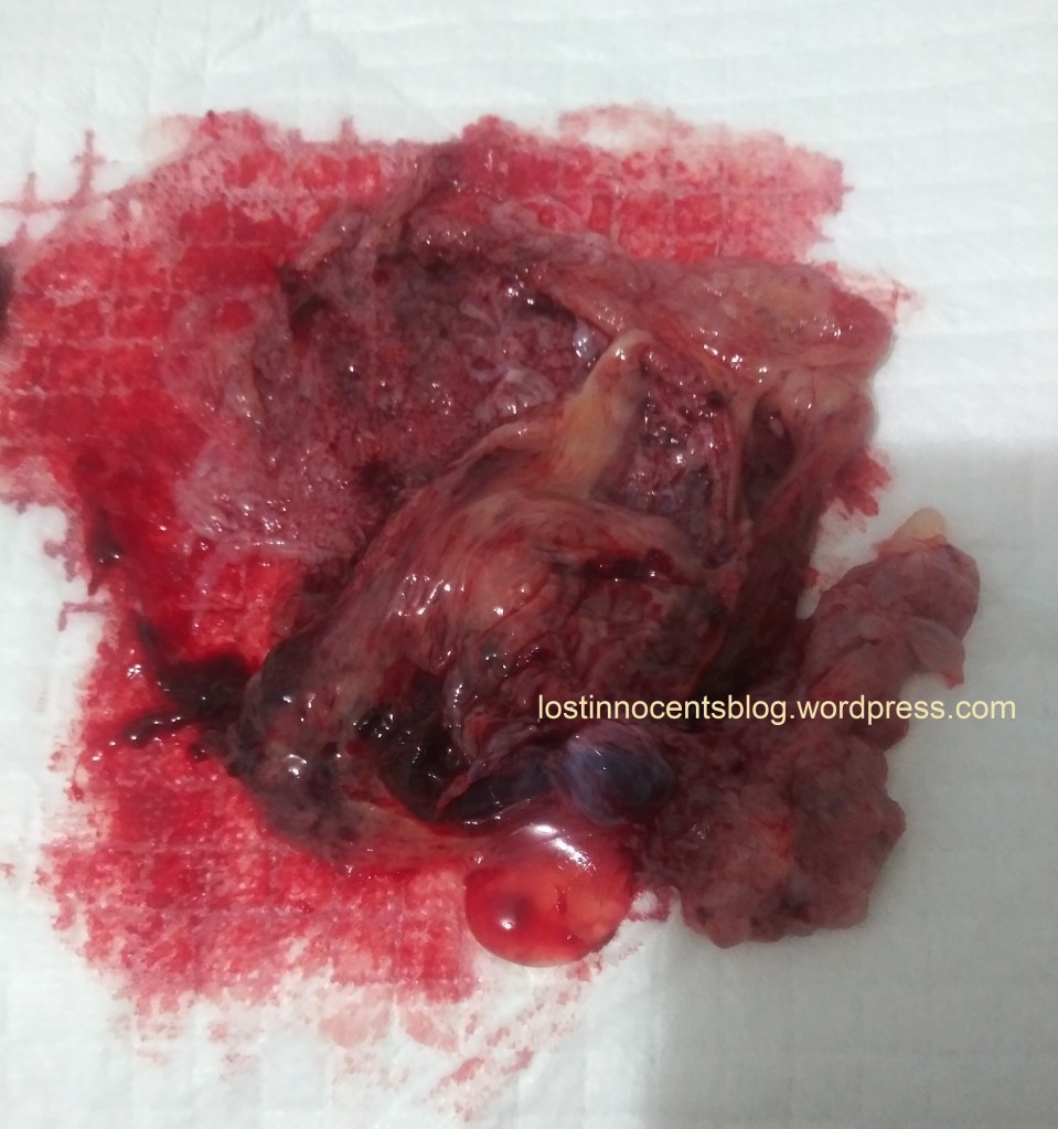 Heavenly's twins - Cedar 5 weeks near placenta WM